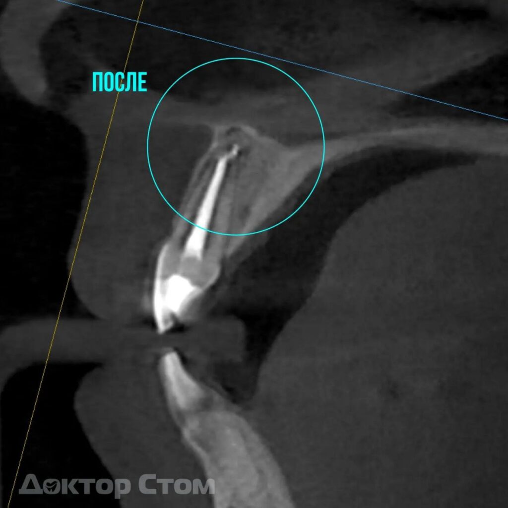 Клинический случай: спасение переднего зуба
