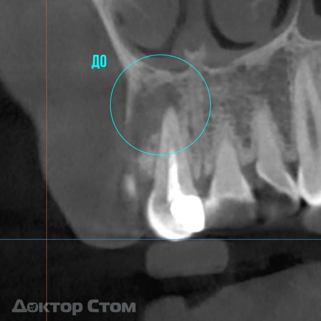 Клинический случай: спасение переднего зуба