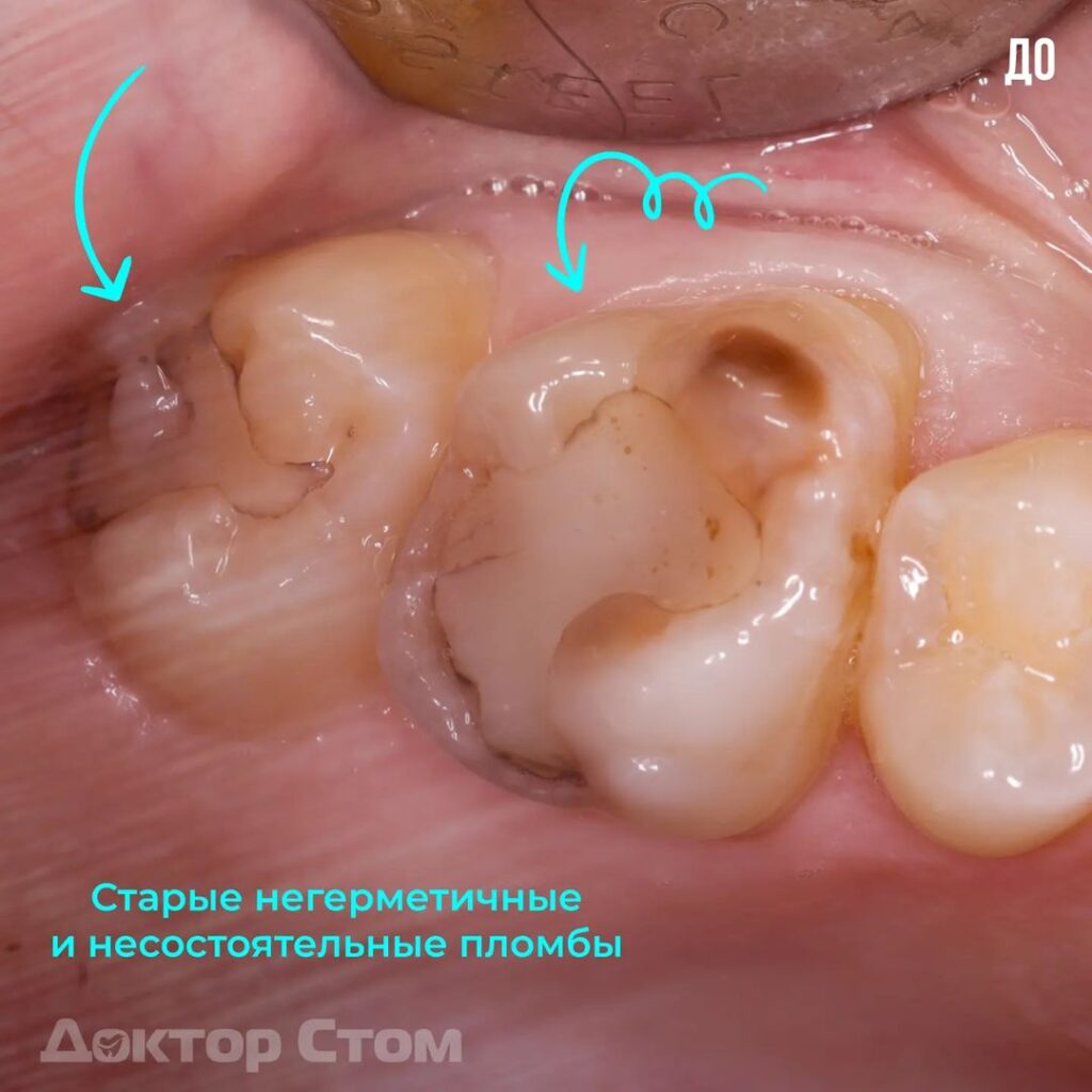Лечение кариеса и реставрация зубов композитным материалом Enamel HRI